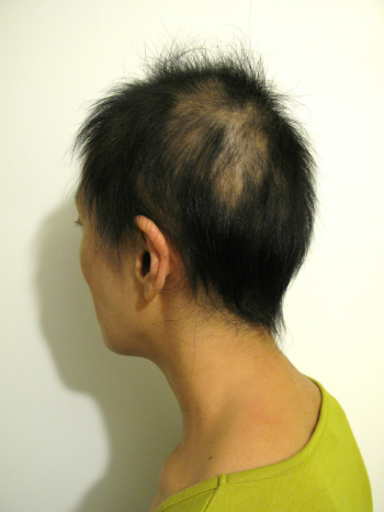 全頭型円形脱毛症 1年 10ヶ月経過 写真